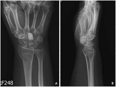 Solitary Calcified Nodules as the Cause of Carpal Tunnel Syndrome: Two Case Reports and Literature Reviews